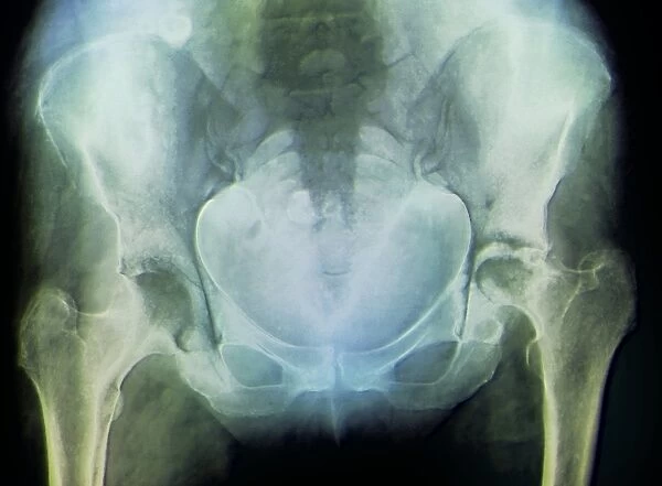 Rheumatoid arthritis of the hip, X-ray