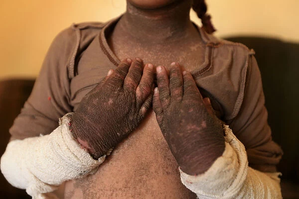 The skin on five-year-old Dos arms and neck is blackened after a rocket fired by