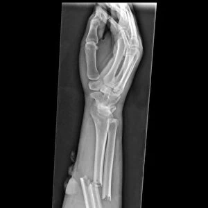 Broken arm, X-ray C017 / 7863