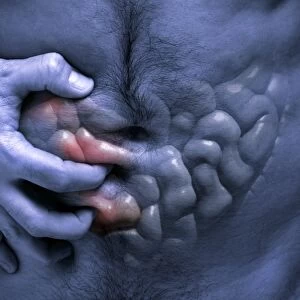 Crohns disease, artwork