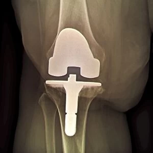 Prosthetic knee and obesity, X-ray C016 / 6594