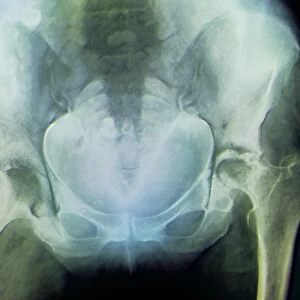 Rheumatoid arthritis of the hip, X-ray