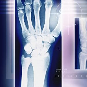 Wrist bones, X-ray