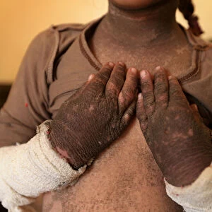 The skin on five-year-old Dos arms and neck is blackened after a rocket fired by