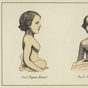 Pigeon-chested girl (colour litho)