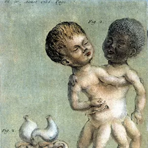 Plate of medicine representing Siamese brothers: a white and a black